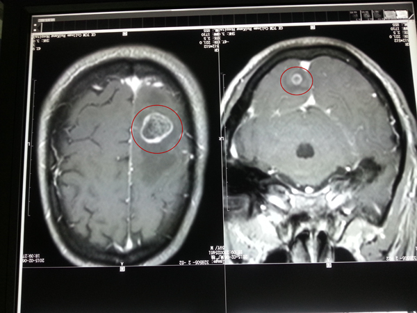 肠癌患者术后脑转移致偏瘫射波刀治疗3次肢体功能恢复