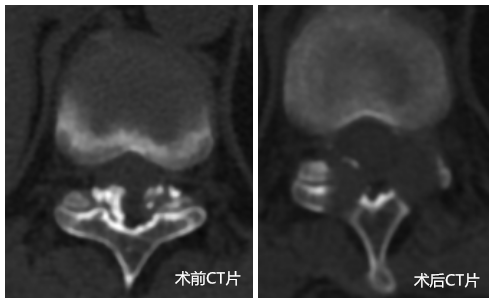 脊柱外科一区成功完成广西首例“胸椎”孔镜术