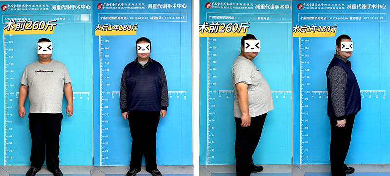 3患者术前及术后1年对比.jpg
